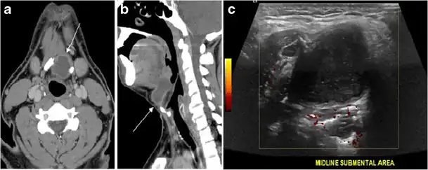 Fig. 20. Recurrent/residual thyroglossal duct cyst in a 39-year-old male patient. The first resection of thyroglossal duct cyst showed histopathology evidence of Hurthle cell type thyroid cancer. However, the second resection showed signs of chronic inflammation, with no malignant cells. a, b Enhanced axial and sagittal neck CT scans demonstrate a unilocular cystic lesion arising from the tongue base and extending through the partially resected hyoid bone. This cystic lesion has a peripheral enhancing wall, which becomes more thick over its inferior aspect associated with surrounding fat stranding at the surgical site (white arrow). There are no internal septations, nodules or masses, or calcifications. c Transverse view of power Doppler ultrasound at the submental area demonstrates cystic lesion and internal debris with no detected internal vascularity.[1]