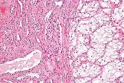 Clear-cell renal-cell carcinoma. HE, × 100