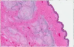Cutaneous Myxoma