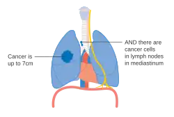 Stage IIIA lung cancer