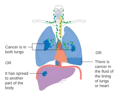 Stage IV lung cancer