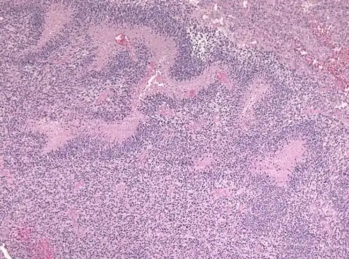Pseudopalisading seen around necrosis in glioblastoma