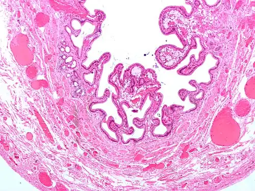 Micrograph of cholesterolosis of the gallbladder