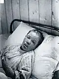 Ethel Cromwell (with smallpox)[4]