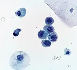 High-grade urothelial carcinoma. A cytologic diagnosis of high-grade urothelial carcinoma requires > 10 cells with high N/C ratio, irregular chromatin pattern and hyperchromatic nuclei (Pap stain).[5]
