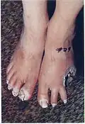 Patient's foot healing after 29 treatments