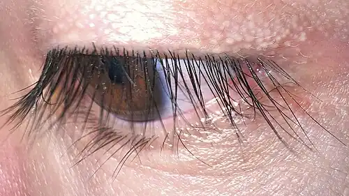 Long, thick, and dark eyelashes are considered an attractive facial feature as they draw attention to the eyes. Subject exhibits trichomegaly (exceptionally long lashes).