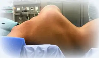 Kyphoscoliosis of the back of someone with kyphoscoliosis EDS