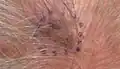 Melanoma in situ, vertex scalp marked for biopsy