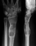 X-ray showing enchondromas localized in the lower part of the radius of a 37-year-old patient affected with Ollier disease