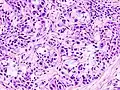 Histopathologic image of mucoepidermoid carcinoma of the major salivary gland. The same lesion as shown in a filename "Mucoepidermoid carcinoma (2) HE stain.jpg". H & E stain