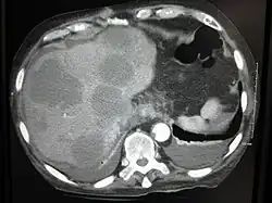 CT image of multiple liver metastases