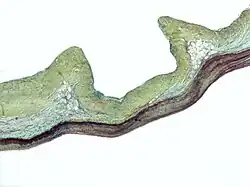 Movat's stain showing thickening of the spongiosa layer (blue) in myxomatous degeneration of the aortic valve