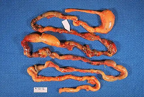 Esophagus, stomach and intestines of affected infant showing intestinal necrosis, pneumatosis intestinalis, and intestinal perforation (arrow) (autopsy specimen)