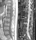 (a) T1-weighted and (b) STIR MRI of lumbar and lower thoracic spine in PsA showing active inflammation at several levels (arrows), anterior spondylitis at L1/L2, and an inflammatory Andersson lesion at the upper vertebral endplate of L3.