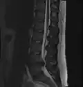 A rather severe herniation of the L4–L5 disc