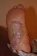 Keloid in the sole in a patient with large keloids elsewhere