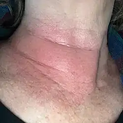 Erythema migrans ("migrating redness") and may have no definite pattern, as in this Lyme rash on a woman's neck. Rashes from non-Lyme causes may look similar.