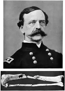 Sickles above his shattered leg