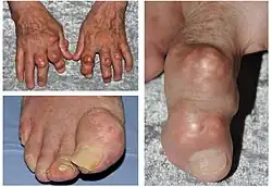 photos of hands and feet affected by gout.