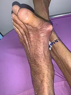 Gouty tophus of the left metatarsophalangeal joint, causing hallux valgus