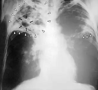 Chest X-ray of a person with advanced tuberculosis