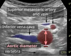Compression is used in this ultrasonograph to get closer to the abdominal aorta, making the superior mesenteric vein and the inferior vena cava look rather flat.