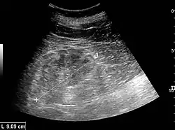 Figure 22. Chronic renal disease caused by glomerulonephritis with increased echogenicity and reduced cortical thickness. Measurement of kidney length on the US image is illustrated by '+' and a dashed line.[1]